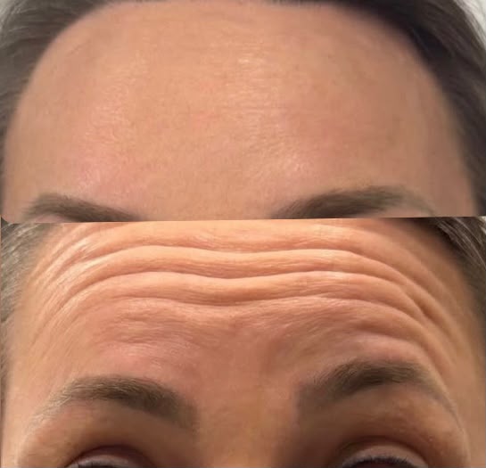 Toxina Botulínica